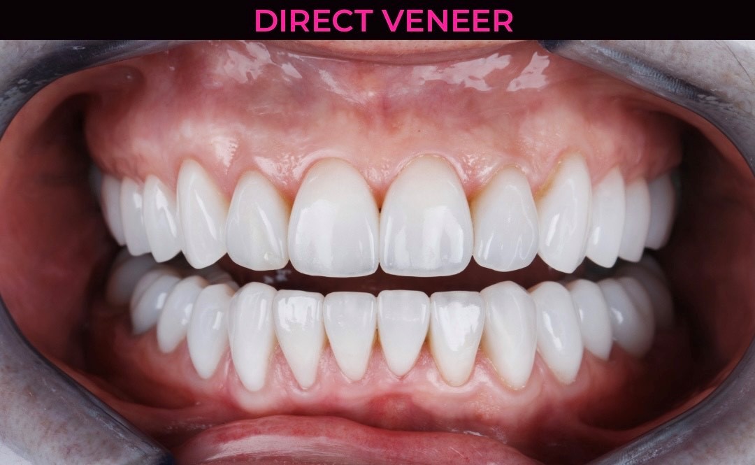 Direct Veneer