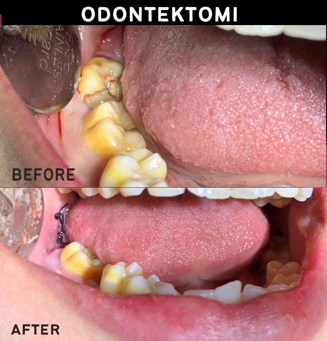 Odontektomi