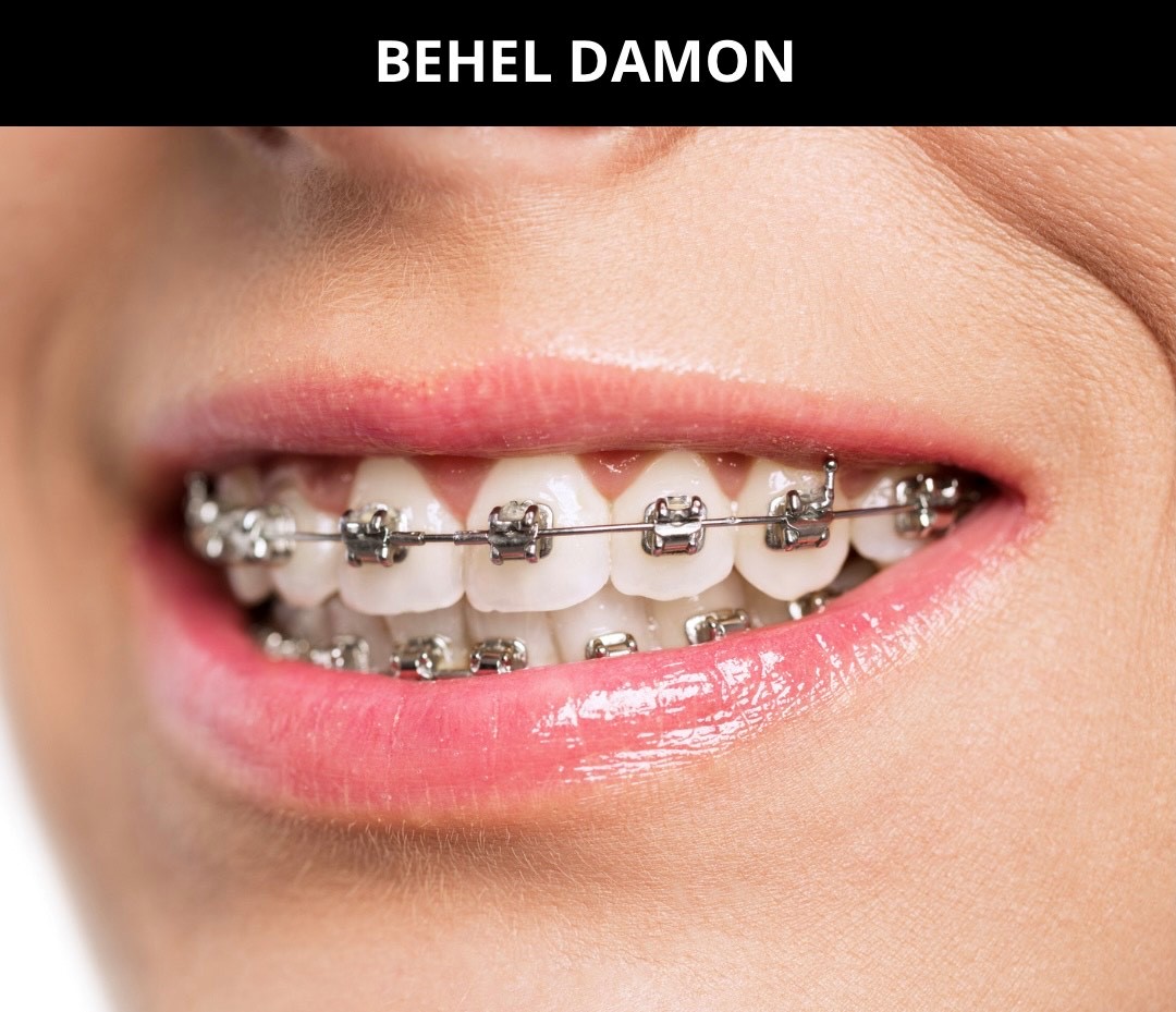 Behel Damon