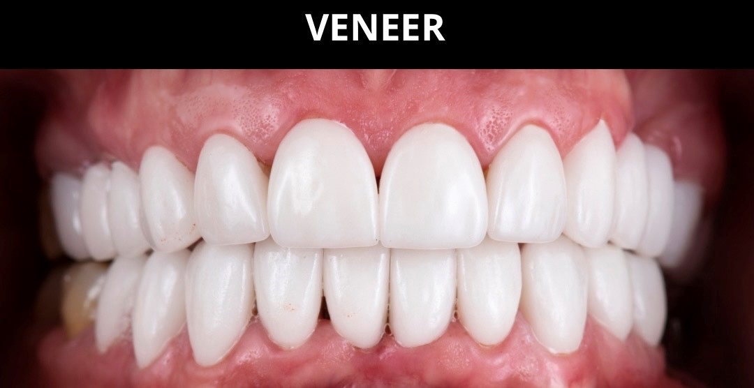 Indirect Veneer