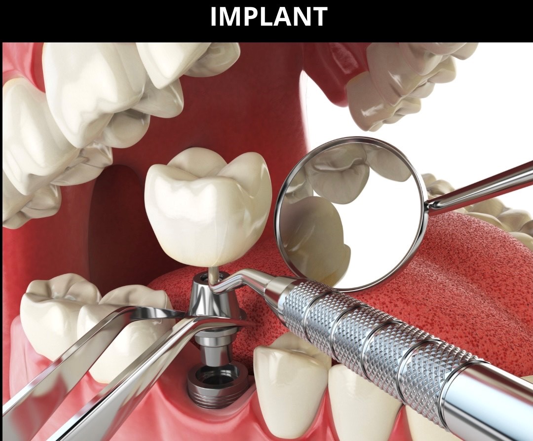 Implant 