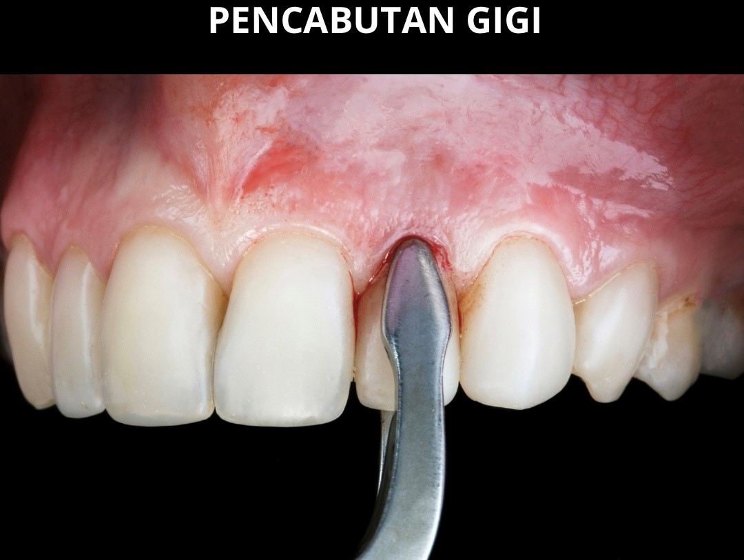 Pencabutan Gigi